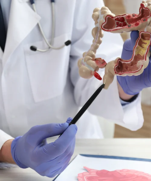 Diagnóstico y manejo de diverticulitis en Guadalajara con el Dr. Diego Acevedo Luna